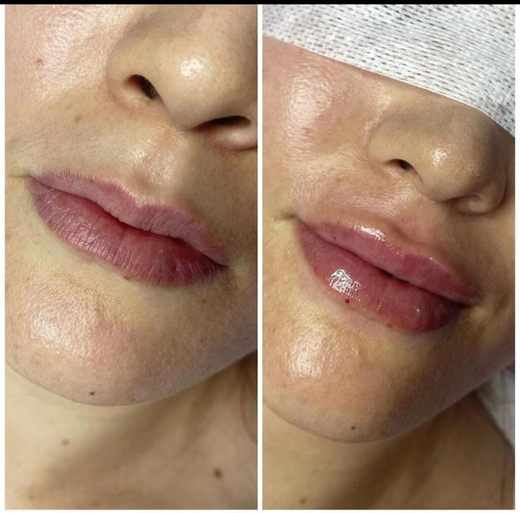 Side-by-side before and after images of a lip augmentation procedure, highlighting fuller, more defined, and glossy lips.