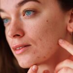 SSC-Hope-for-severe-acne-treatment