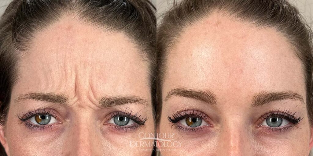 Before and after close-up of a woman’s forehead showing significantly reduced frown lines following wrinkle reduction injections.