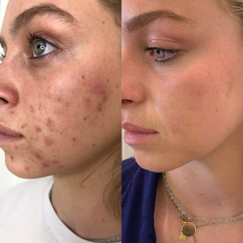 A close-up of a client undergoing a deep sea chemical peel treatment, designed to exfoliate and improve skin texture.